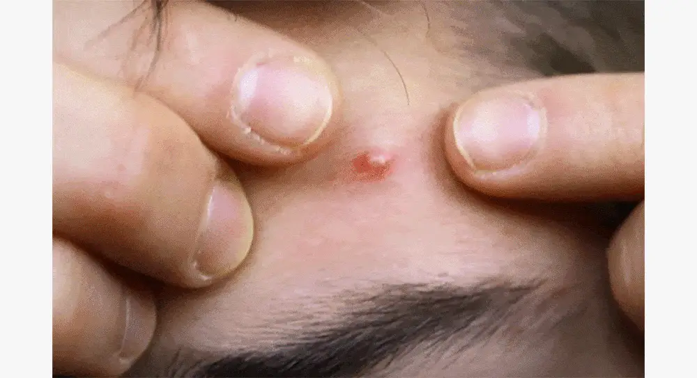 [트러블부위 진정케어] 피캄 센텔라 트러블 스팟 15ml 상세페이지 5